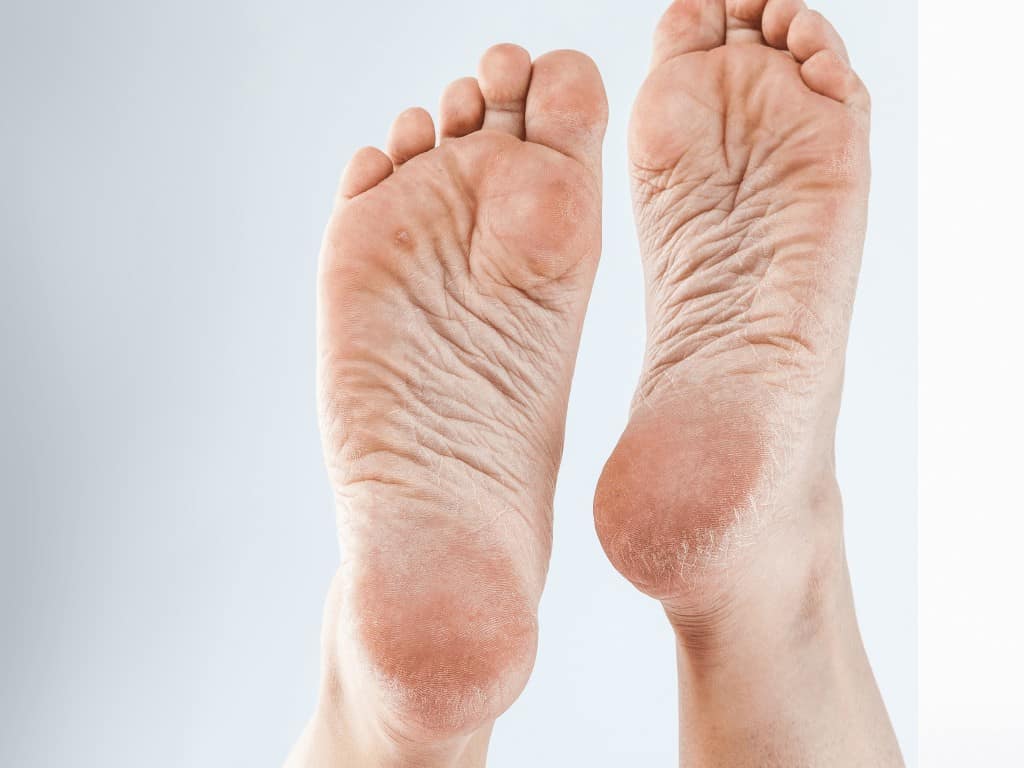 Signs of Cracked Heels