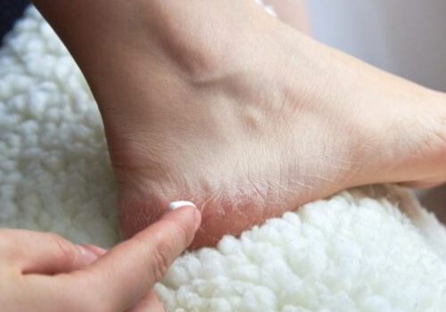 Treat Cracked Heels with Vaseline