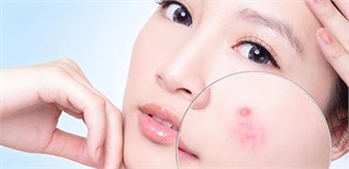 Làm sao để mụn không tấn công sau Tết