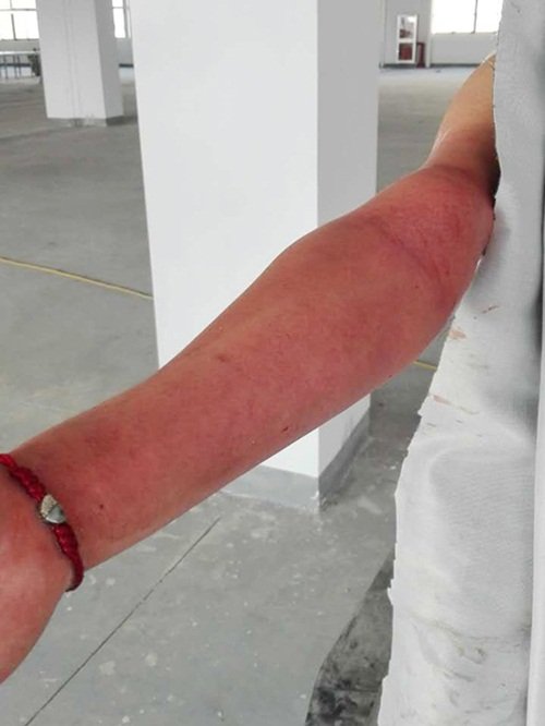 Cánh tay đau rát khi bị kẹt dưới bồn cầu