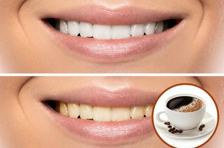 Các lý do khiến răng bạn bị ố vàng