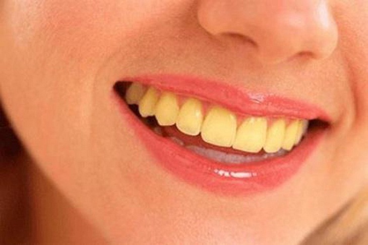 Các lý do khiến răng bạn bị ố vàng