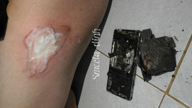 Và để lại một vết bỏng khá lớn Và để lại một vết bỏng khá lớn