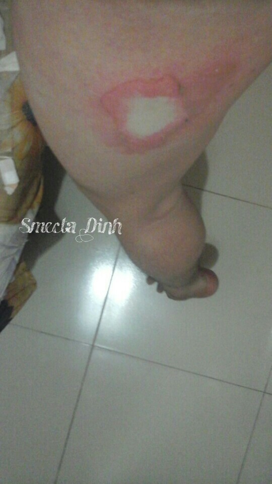 Và để lại một vết bỏng khá lớn Và để lại một vết bỏng khá lớn