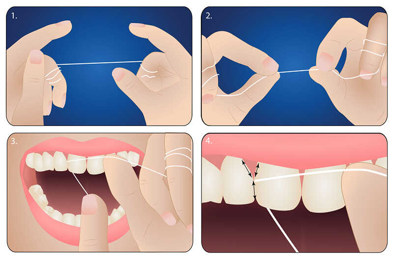 Cách sử dụng chỉ nha khoa cho răng hàm
