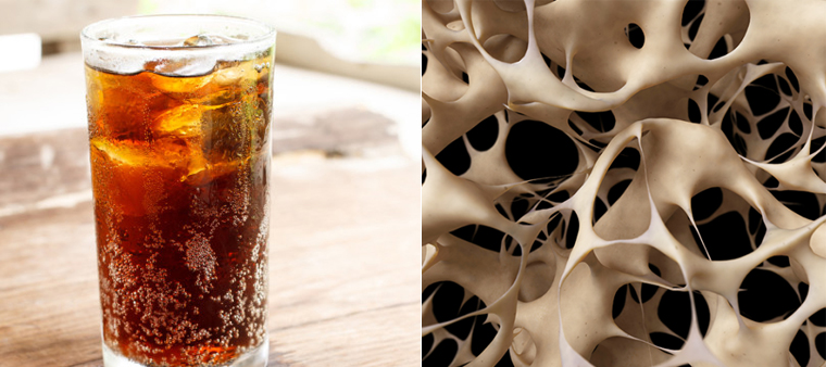 Bé uống nhiều nước ngọt tăng nguy cơ loãng xương, còi xương