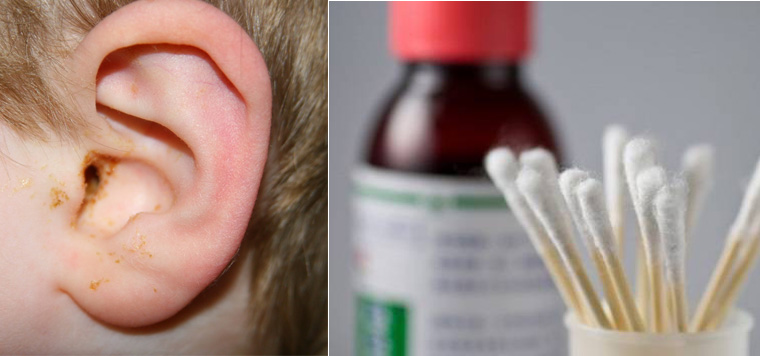 Khi ráy tai quá nhiều và ảnh hưởng đến chức năng nghe thì cần lấy ráy tai cho bé