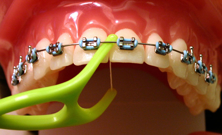 Vệ sinh răng miệng bằng chỉ nha khoa sau khi niềng răng