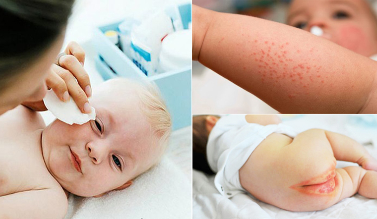 Khăn ướt có thể gây nhiều tác hại lên da bé Khăn ướt có thể gây nhiều tác hại lên da bé
