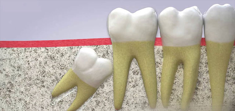 Cách dùng bàn chải đánh răng sau khi nhổ răng khôn Cách dùng bàn chải đánh răng sau khi nhổ răng khôn