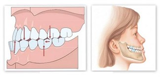 Cách chọn bàn chải đánh răng cho răng vẩu