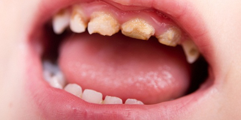 Có nên lấy cao răng cho trẻ như người lớn?