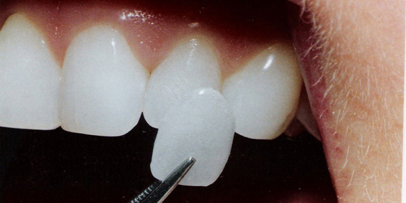 Sau khi bọc răng sứ, vệ sinh răng miệng như thế nào là hợp lí?