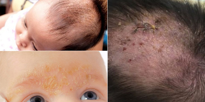 Cứt trâu có thể mọc trên da đầu, kéo lan xuống vùng mặt và cổ, có nguy cơ gây bội nhiễm Cứt trâu có thể mọc trên da đầu, kéo lan xuống vùng mặt và cổ, có nguy cơ gây bội nhiễm