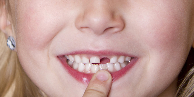 Chăm sóc cẩn trọng vùng răng bị tổn thương sau khi nhổ răng