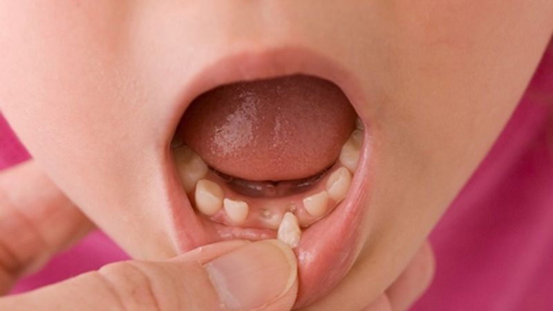 Răng sữa khi bị nhiễm trùng phải được nhổ ngay