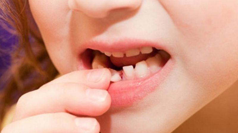 Nhổ răng sữa cho bé ở nhà cần lưu ý một số vấn đề