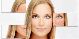 Cách trị nám và tàn nhang SIÊU RẺ vô cùng HIỆU QUẢ