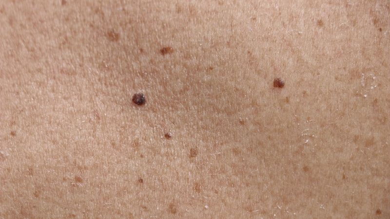Nốt ruồi là một dạng sắc tố da lành tính, xuất hiện trên da với đa dạng kích thước