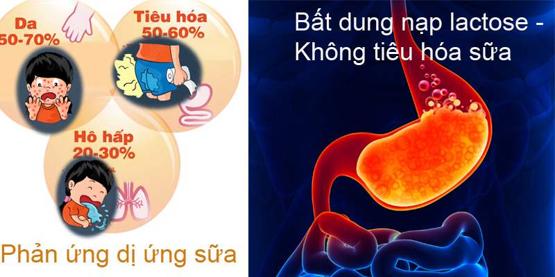 Phân biệt dị ứng sữa bò và bất dung nạp lactose Phân biệt dị ứng sữa bò và bất dung nạp lactose