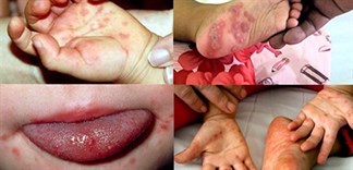 Hướng dẫn cách chăm sóc trẻ bị bệnh tay chân miệng tại nhà