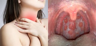 Viêm họng hạt: Những điều cần biết và cách phòng tránh
