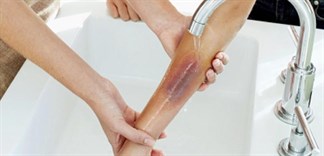 Người đàn ông bị bỏng nặng do hóa chất tẩy rửa bồn cầu