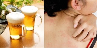 Vì sao bạn bị dị ứng bia?