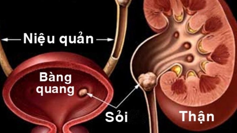 Không tốt cho người bị sỏi thận