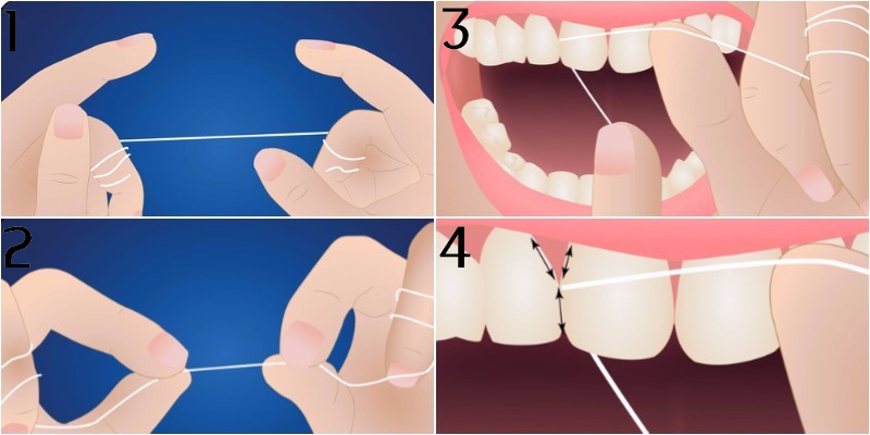 Khi nào bắt đầu cho trẻ dùng chỉ nha khoa?