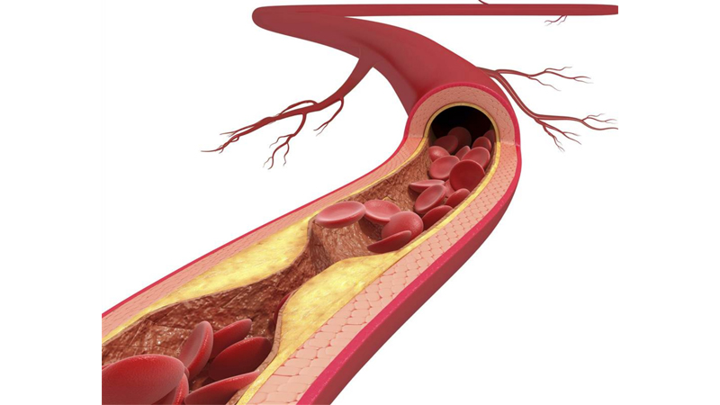 Cá ngừ giúp ngăn ngừa xơ vữa động mạch