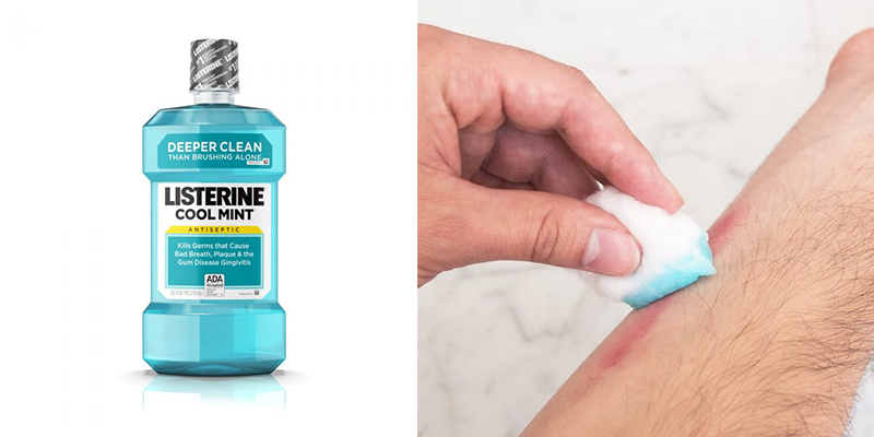 Thoa Listerine lên chỗ ngứa