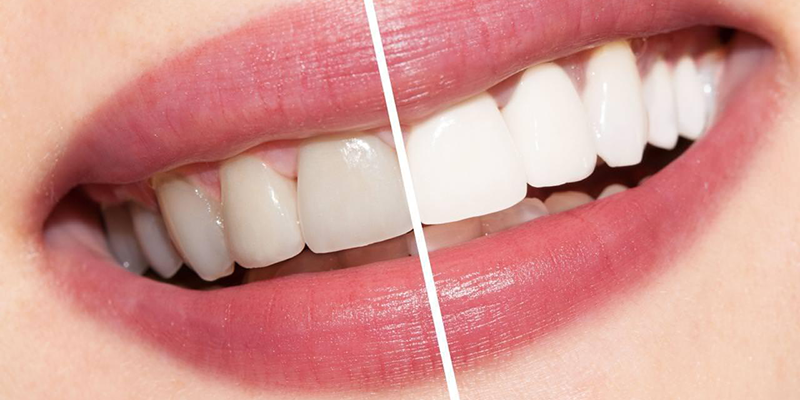 listerine sử dụng đúng cách sẽ khiến răng bạn trắng sáng hơn