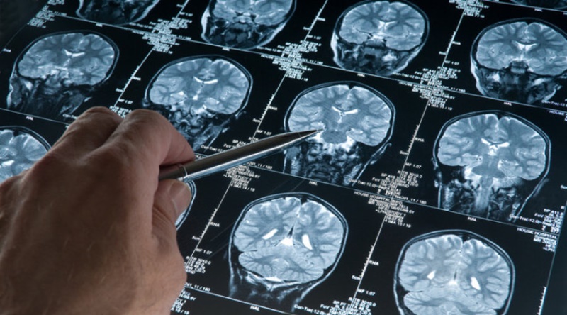 Chụp cắt lớp não giúp phát hiện sớm chứng tự kỷ ở trẻ