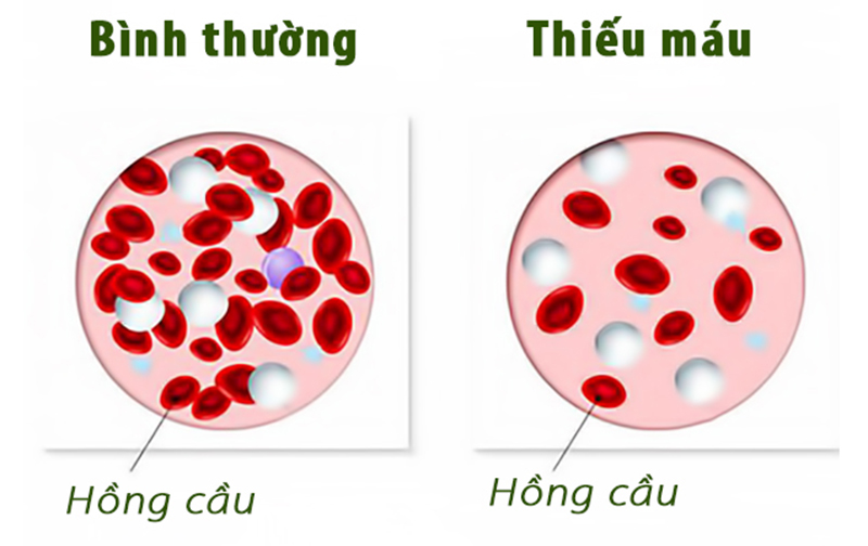 Thiếu máu