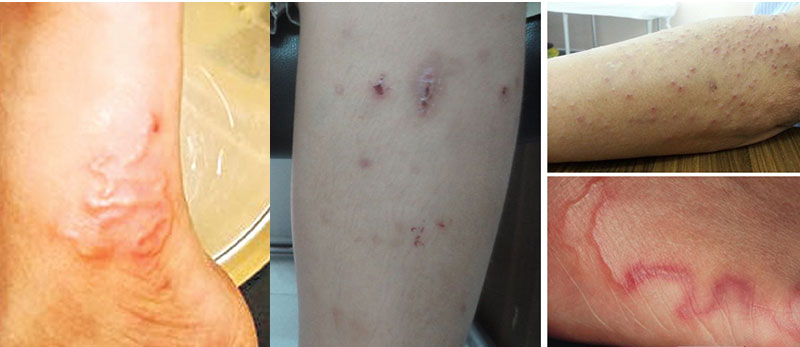 Triệu chứng nhiễm giun sán ở người lớn Piraz 6mg hộp 4 viên - Hỗ trợ điều trị giun sán