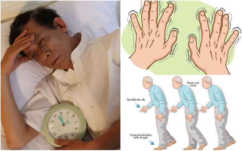 Triệu chứng Parkinson