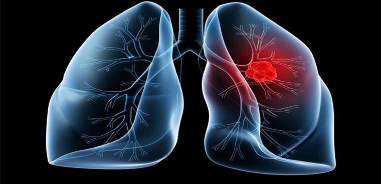 Có những dấu hiệu nào có thể cho thấy sự xuất hiện của u phổi?
