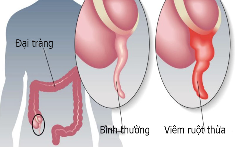 Nguyên nhân viêm ruột thừa