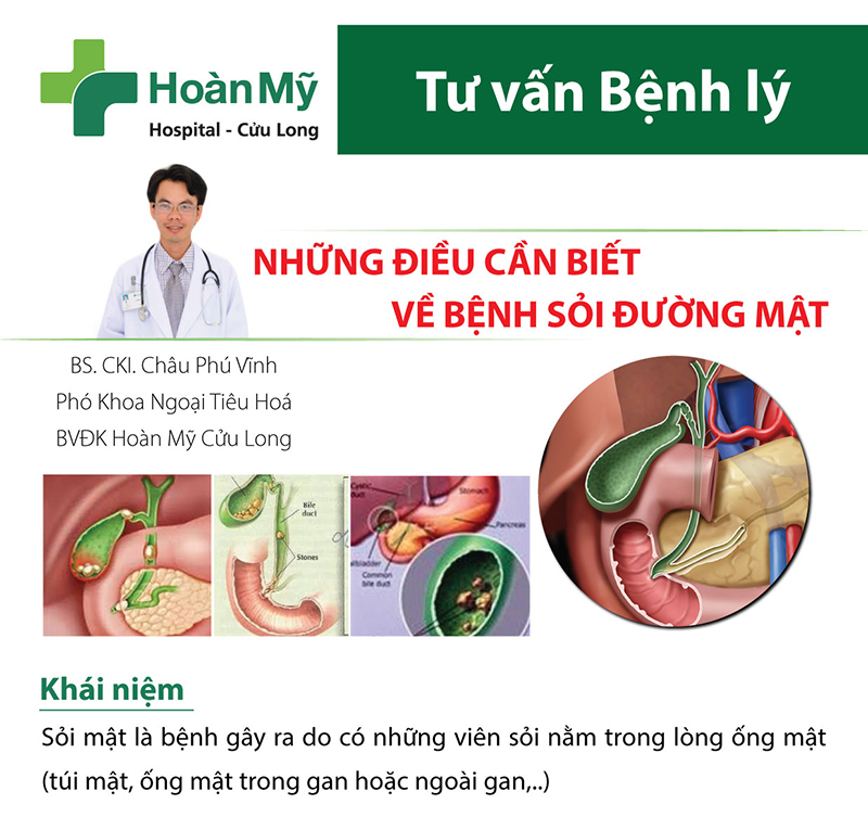 Sỏi mật