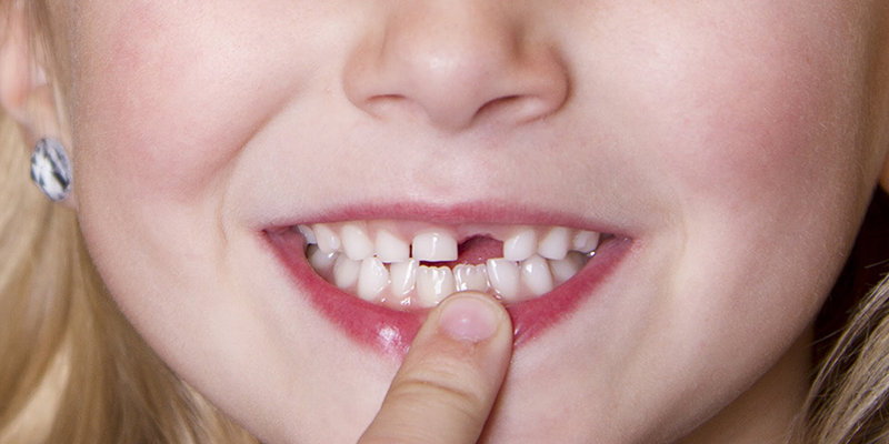 uống nhiều nước ngọt có gas gây ảnh hưởng xấu tới men răng