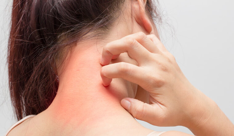 Những triệu chứng dị ứng thức ăn bạn không nên bỏ qua