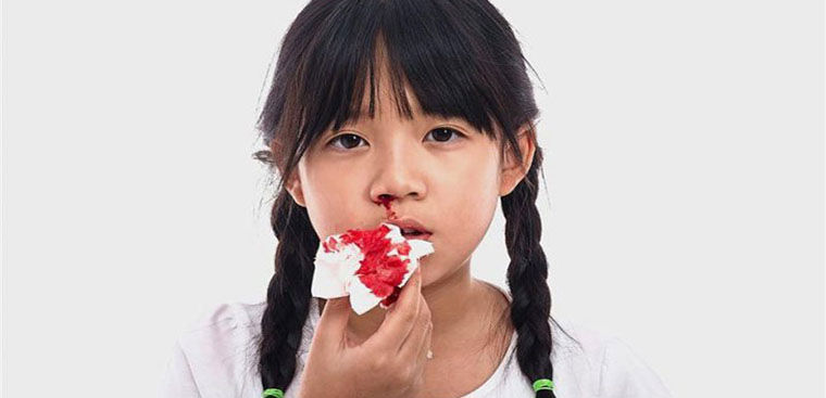 Chảy máu mũi có thể dẫn đến biến chứng nào?
