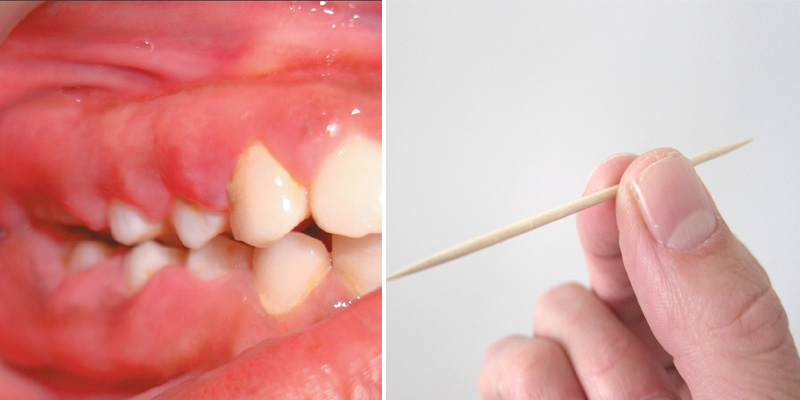 Tại sao bạn nên ngừng sử dụng tăm xỉa răng?-5