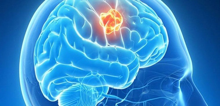 Khối u não có thể làm suy giảm chức năng của não không?
