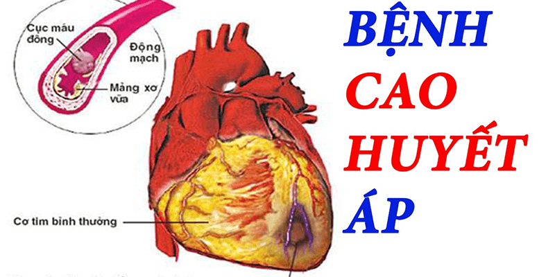 Bệnh cao huyết áp có nguy cơ dẫn đến đột quỵ, thậm chí có thể tử vong