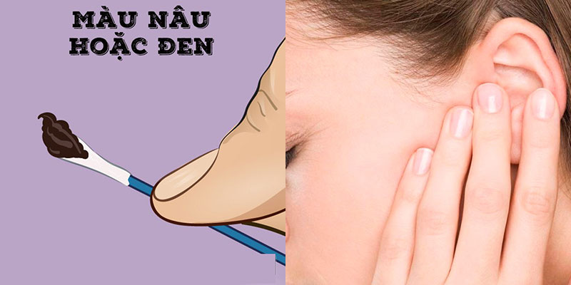 Tai màu tối có thể là do bệnh nấm tai