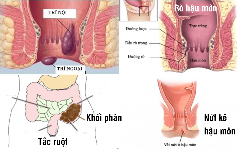 Biến chứng bệnh táo bón