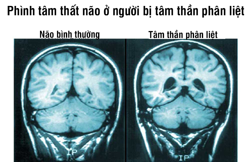 Phình tâm thất não ở người bị tâm thần phân liệt