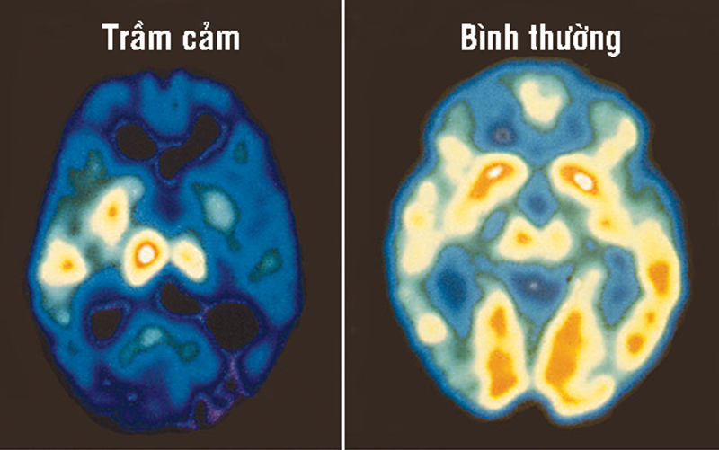 Thành phần các chất hóa học trong não người mắc bệnh trầm cảm khác với người bình thường